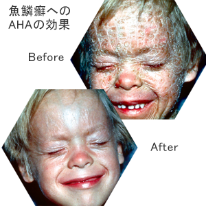 AHAによる魚鱗癬(ぎょりんせん)の治療画像 Before ＆ After